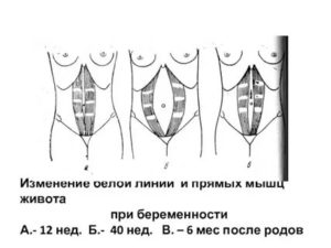 Напряжение мышц живота при беременности