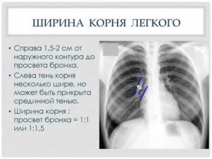 Что значит корни малоструктурные на рентгене?