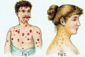 Можно ли через массаж заразиться кожными заболеваниями и сифилисом?