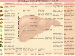 Можно ли соблюдать рост после удаления желчного пузыря