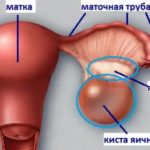 Можно ли верить Igen тесту Гринвэй?