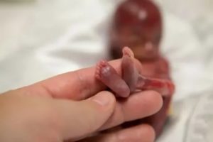 Аборт на 17 неделе беременности