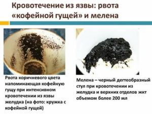 Как отличить мелену от черного стула?