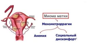 Миома матки и низкий гемоглобин