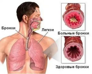 Тяжесть в бронхах и легких