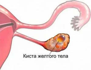 Кровоизлияние в кисту жёлтого тела, боли