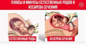 Естесственные роды или кесарево сечение