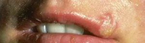 Герпес на губе после орально-генитального контакта