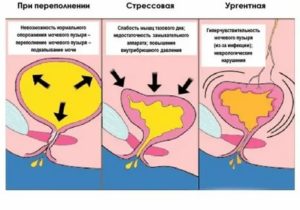 Месячные идут только во время мочеиспускания